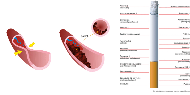 Ce que fait le tabac aux artères (dès l’adolescence)